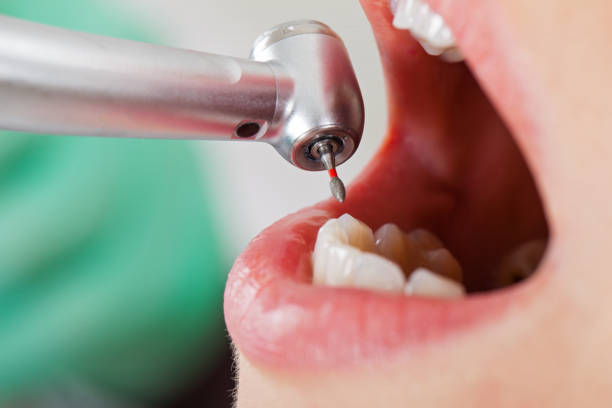Best Broken or Chipped Tooth Repair in Pleasant Hill, CA